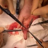 6-летней девочке успешно пришили палец, пострадавший от рук отчима