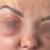 Жертвой опасного препарата для удаления мешков под глазами стала жительница Брянска