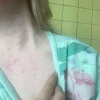 Петербурженка попала в больницу с тяжёлой сыпью и отёками после 12-часовой смены на складе OZON в Шушарах.