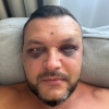 Воронежец лишился зубов из-за жены-изменщицы