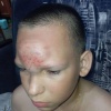 11-летнему школьнику проломили лобную кость во время прогулки в Нижегородской области