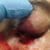 В Набережных Челнах 35-летний рыбак упал глазом на сучок и тот застрял в 8 мм от мозга.
