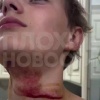 Мальчик на полном ходу влетел шеей в металлический трос в Краснодарском крае