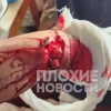В Подмосковье циркулярная пила чуть ли не отрезала подростку кисть. Школьник...