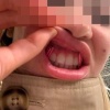 Москвичке сломали челюсть при удалении зуба мудрости.