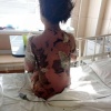 В Воронежской области у 7-летней девочки слезла кожа после приёма лекарства — врач назначила ей препарат без обследований
