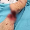 Врачи спасли нижегородцу руку, отрезанную пилой — мужчина снова шевелит пальцами
