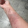 Сотруднице на сельхозпредприятии в Ленобласти, прыснула серная кислота на...