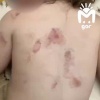 Девочку покусали в садике Дагестана, пока воспитатель -то уходила