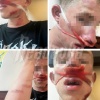 На Сахалине толпа из 30 человек напала на подростков — одного из ребят закидали булыжниками и обокрали