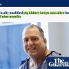 Свиная почка впервые помогла человеку дождаться донорского органа