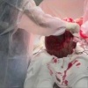 В Калининграде врачи достали опухоль размером с 15-литровое ведро из...