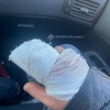Аппарат для хинкали зажевал руку повара