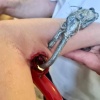 В Подмосковье на одной из детских площадок в руку 10-летнего мальчика впился карабин от качелей