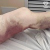 В Подмосковье на даче женщину укусила гадюка После укуса у пострадавшей...