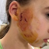 В Калининграде бойцовская собака разорвала лицо 12-летней девочке