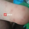 ❗️В Оренбурге ребенок покрылся сыпью после купания в...