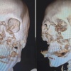 Самокатчик лишился лица после того, как попал в ДТП с другим самокатчиком в Подмосковье