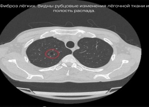 33-летний мужчина умер после многолетнего курения вейпов в Приморье