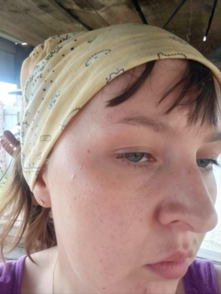 В Чите женщина чуть не сгорела, делая шашлыки: у нее в руках взорвалась бутылка с жидкостью для розжига