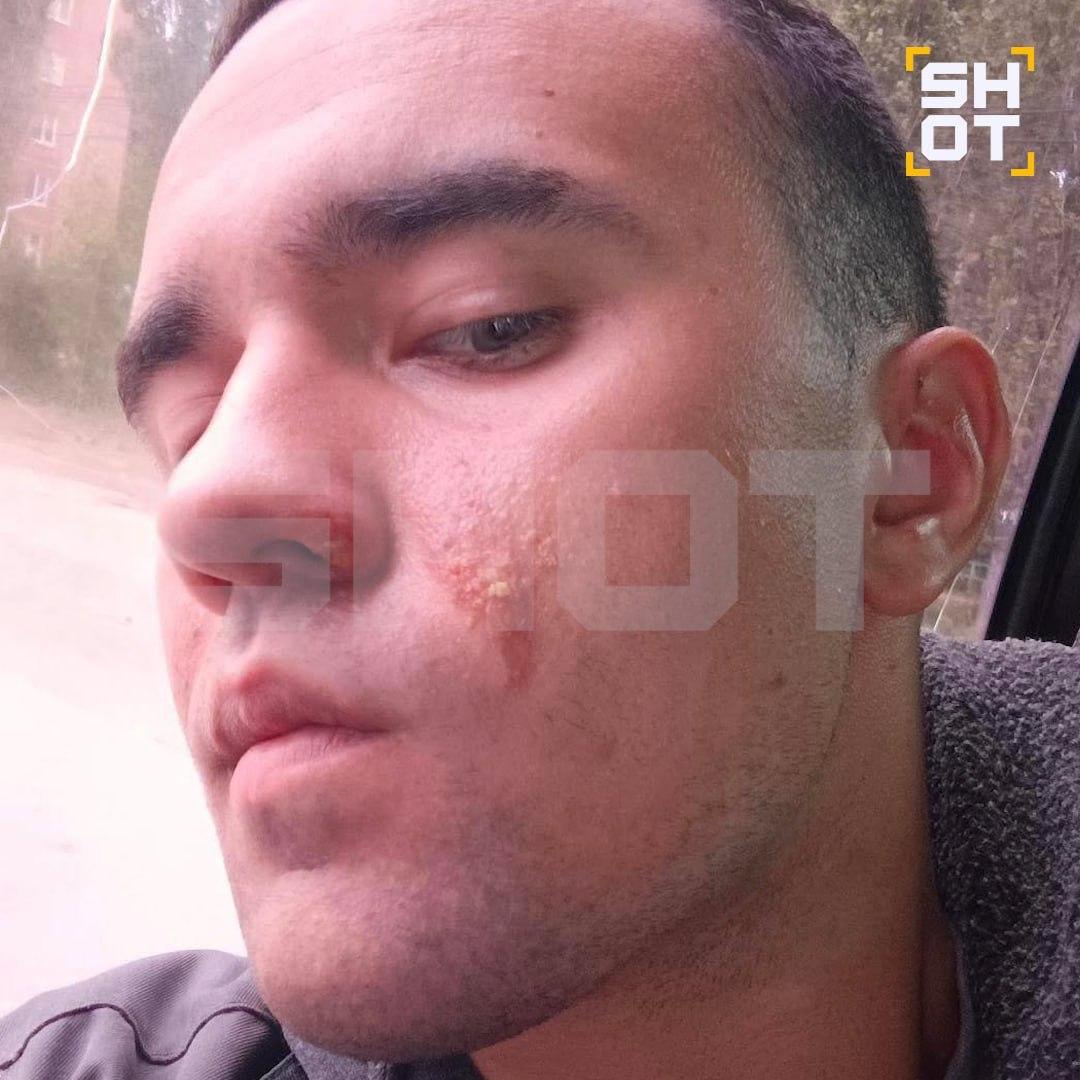 Мужчина спалил лицо, пытаясь повторить модный тренд из Сети на свой день...