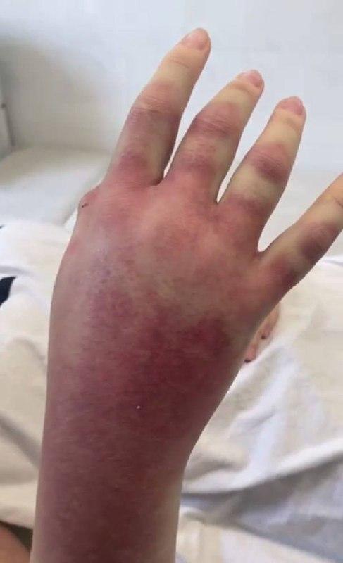 Гадюка напала на дачницу прямо на участке в Подмосковье. У женщины из руки...