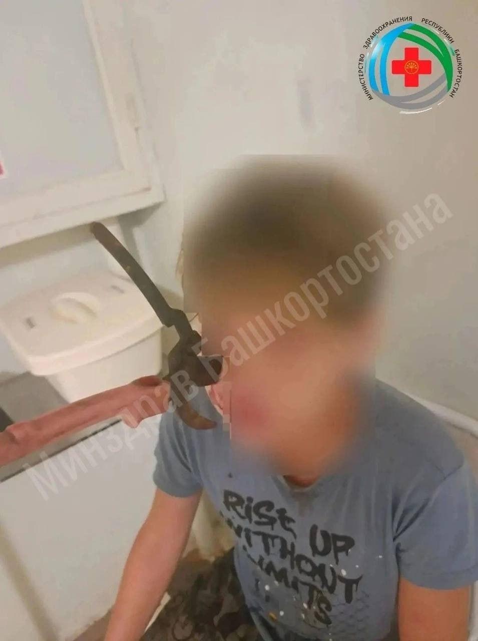 Секатор вонзился в лицо 14-летнему подростку во время игры с братом в...