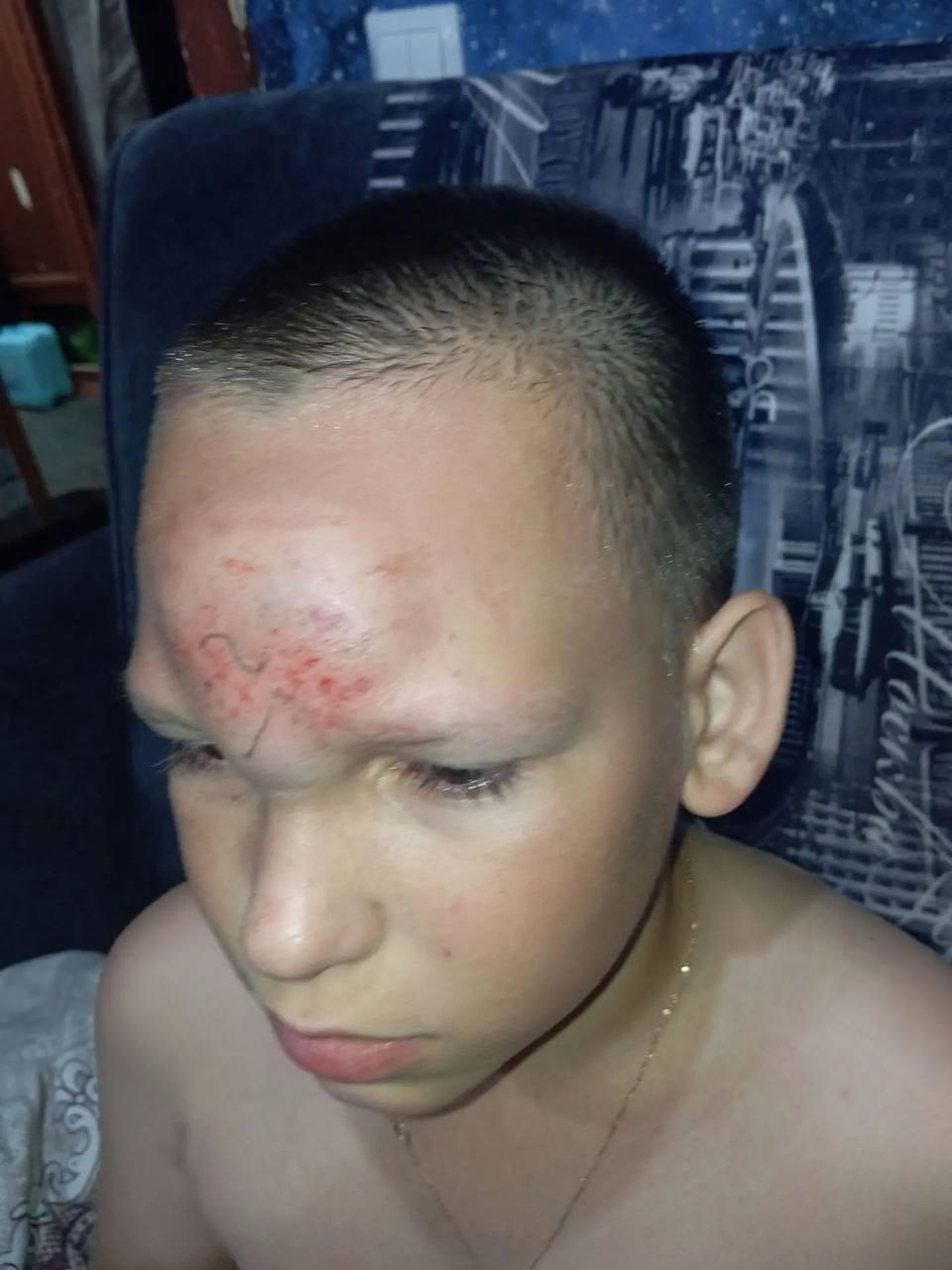 11-летнему школьнику проломили лобную кость во время прогулки в Нижегородской области