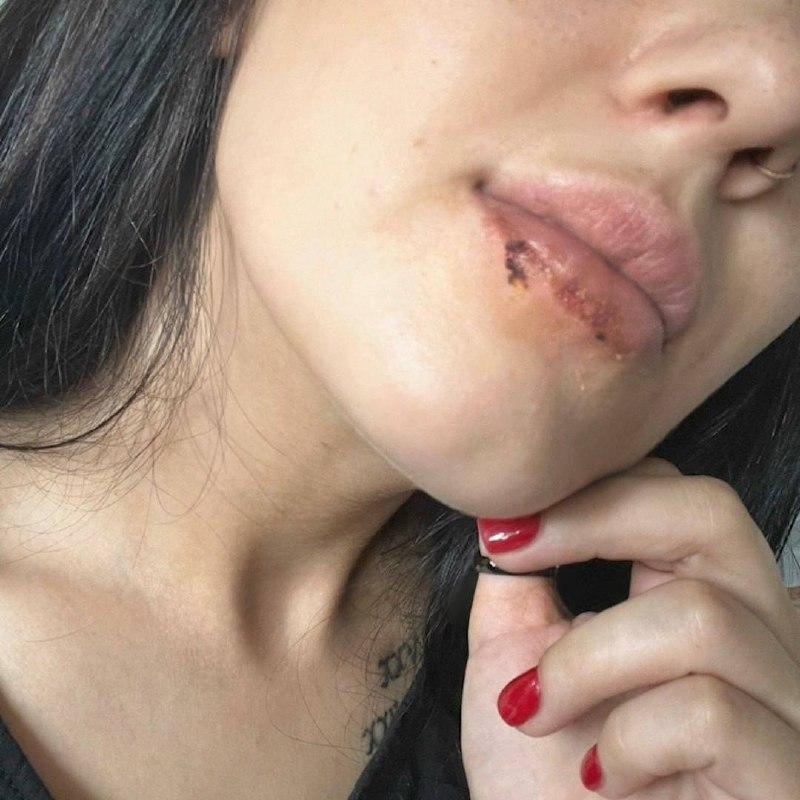В Ачинске девушка получила ожог губ от упаковки мороженого