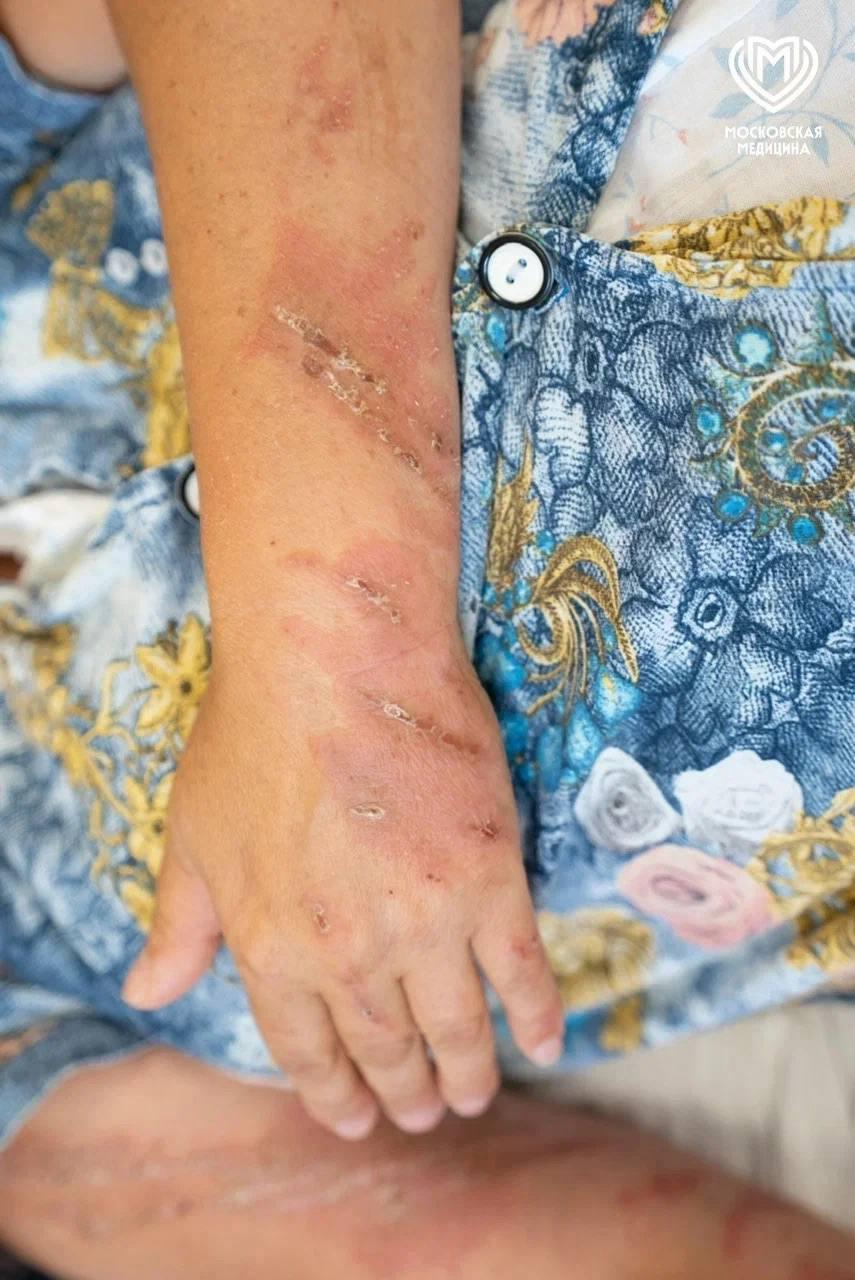 Москвичка получила ожоги из-за конкурента борщевика во время отдыха на юге...
