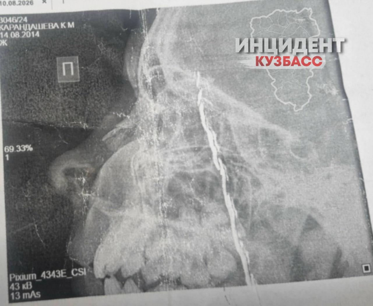 В Кемерове неадекватная женщина проникла в квартиру и избила плоскогубцами двух 12-летних девочек