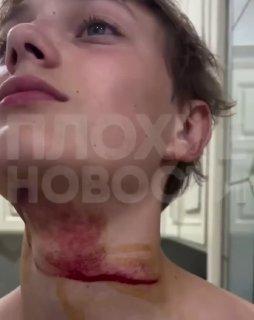 Мальчик на полном ходу влетел шеей в металлический трос в Краснодарском крае