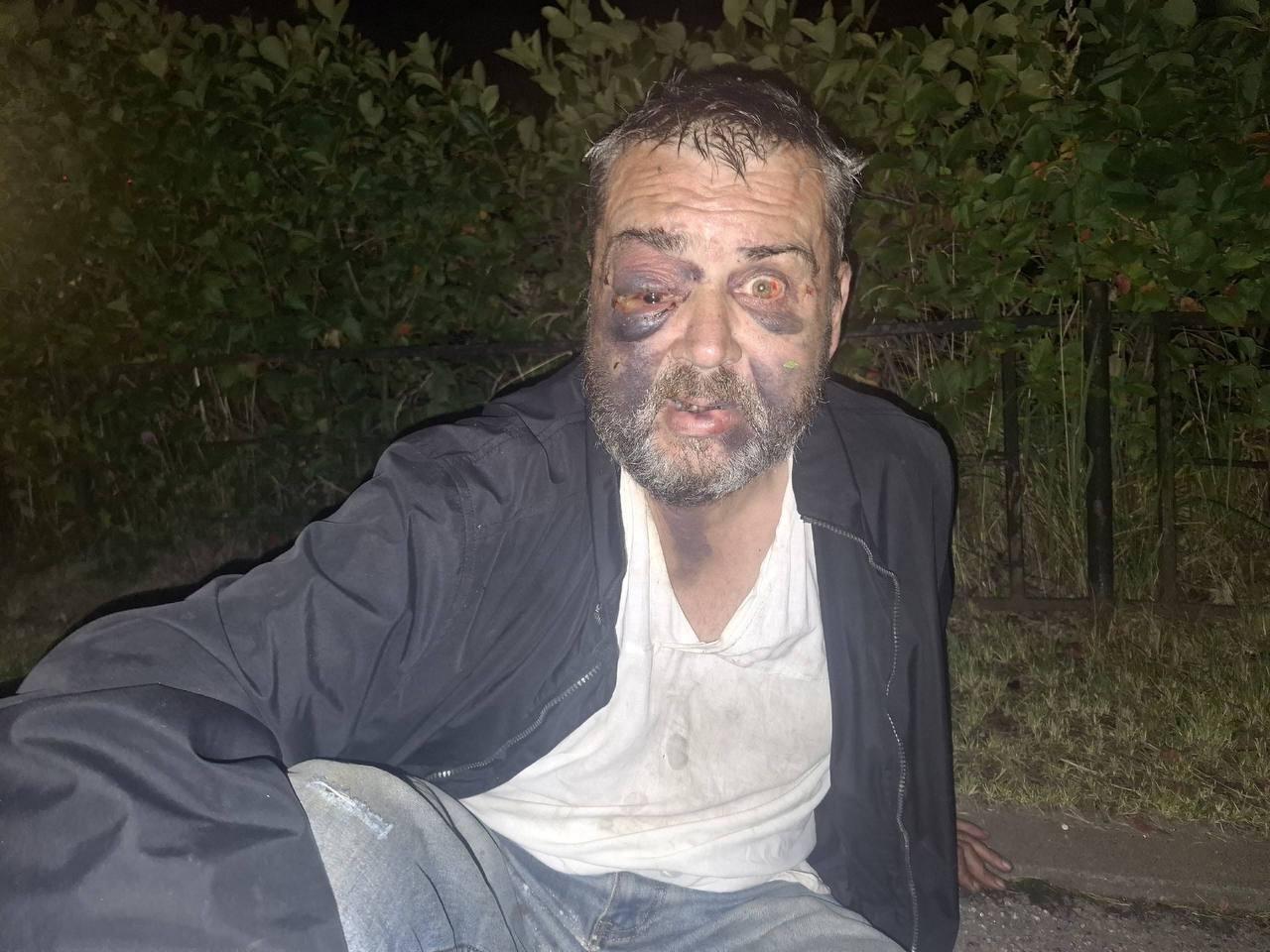 Лицо бомжа, которого сильно избили подростки в Санкт-Петербурге.