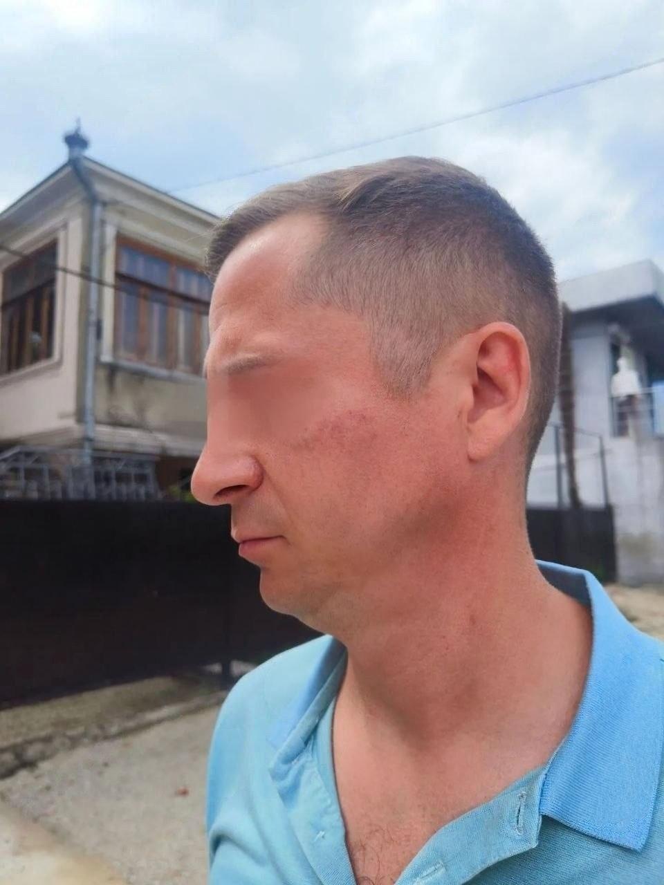 Российских туристов избили толпой в Абхазии. Один из пострадавших утверждает, что слышал крик «Убивай русню»