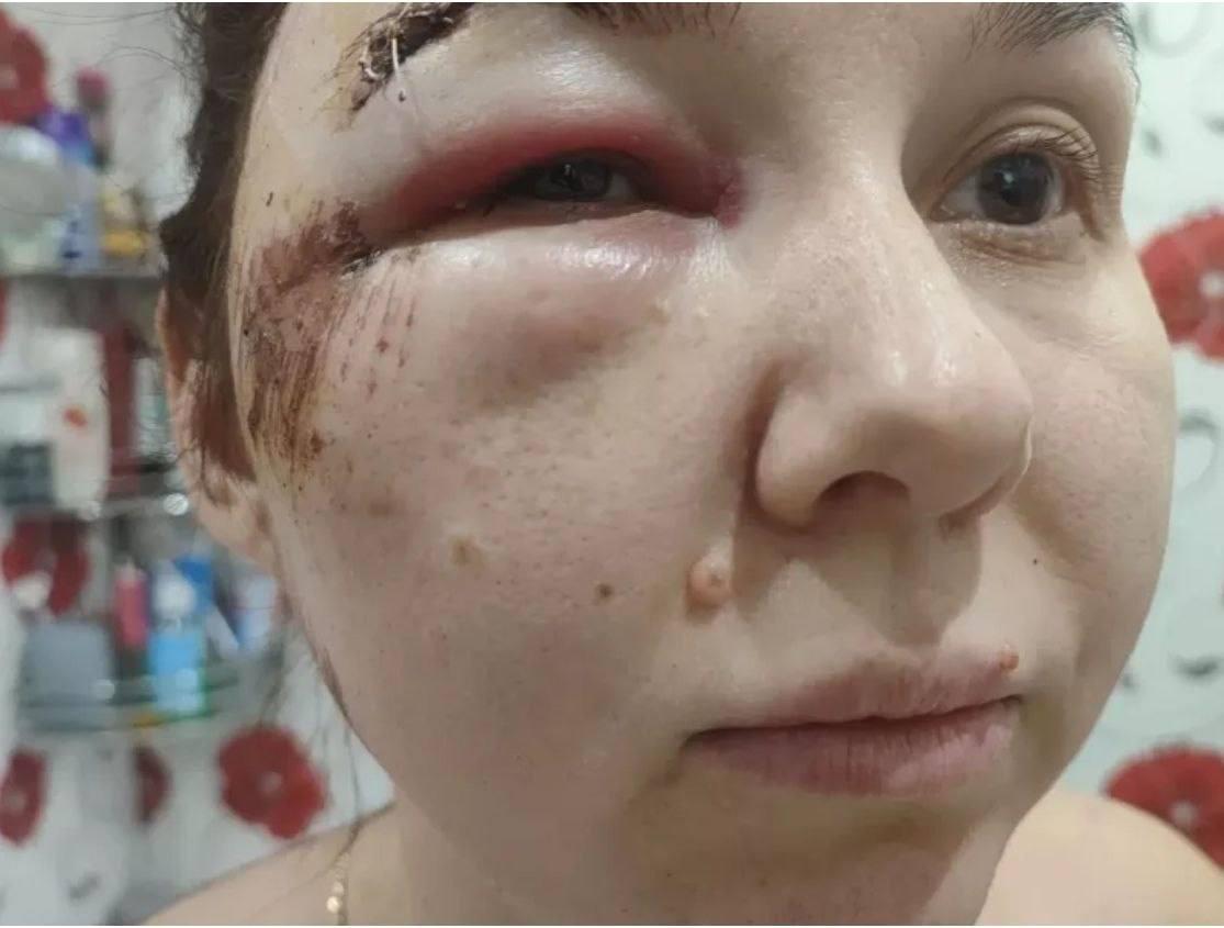Жительница Назарово получила черепно-мозговую травму и сотрясение, упав в...