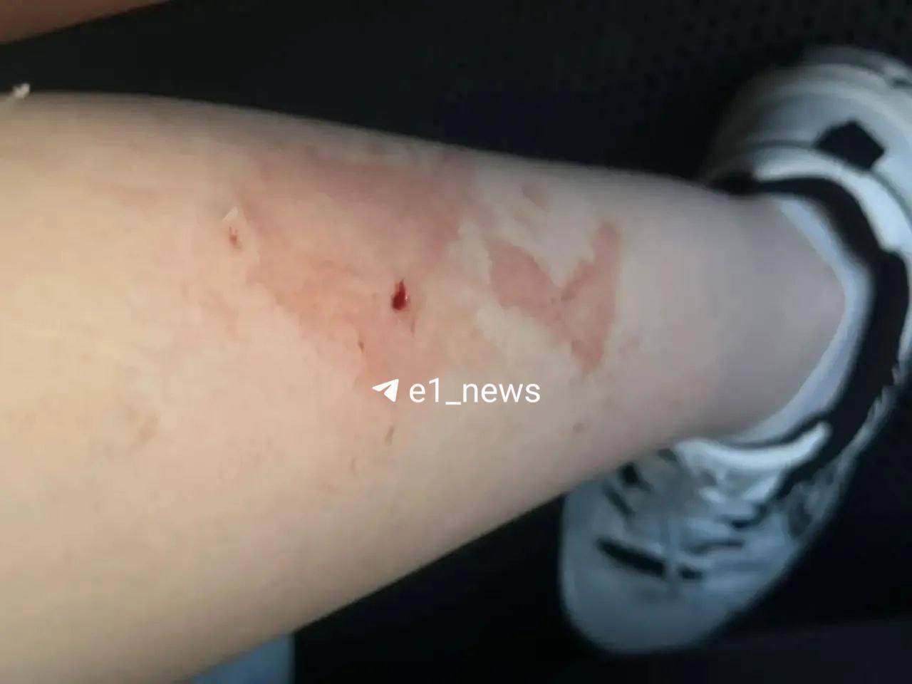 В Екатеринбурге стая собак напала на 16-летнюю девушку по дороге в колледж