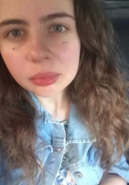 Редкую болезнь Верльгофа обнаружили у 24-летней москвички после того, как её...