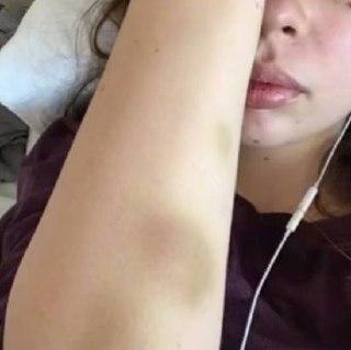 Редкую болезнь Верльгофа обнаружили у 24-летней москвички после того, как её...