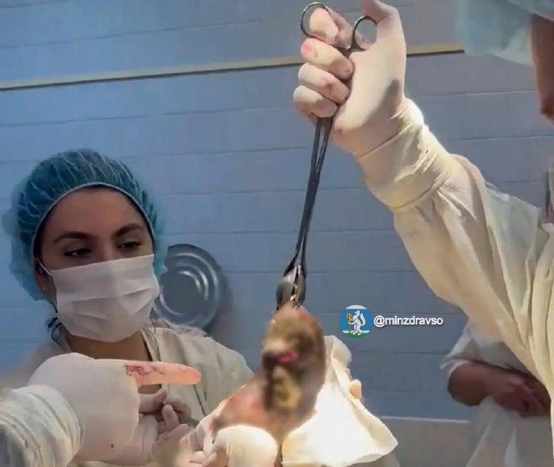 Хирурги достали из желудка молодой девушки полукилограммовый ком волос....