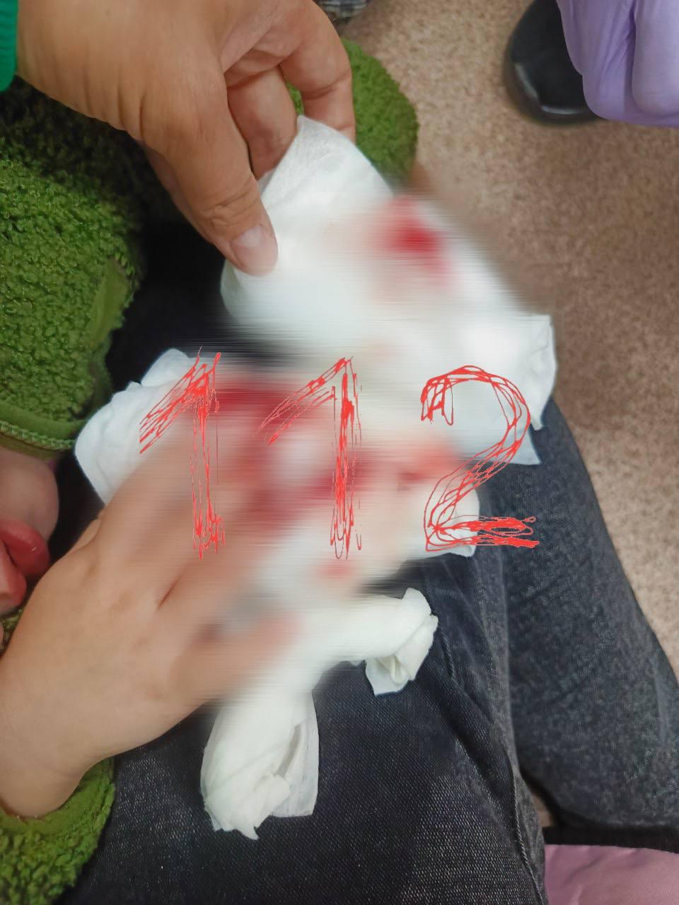 Двухлетней девочке потребовалась операция после того, как она прищемила...