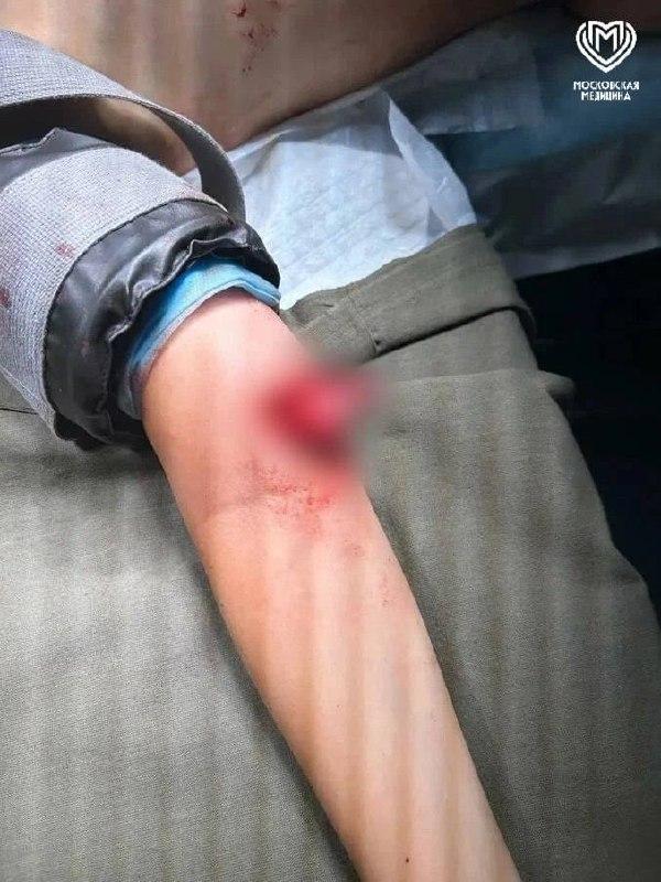 В Подмосковье ребенок упал с питбайка и сломал плечо Девятилетний мальчик...