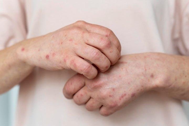 Вспышку оспы обезьян заподозрили в Подмосковье — сразу пять человек попали в больницу в Жуковском.