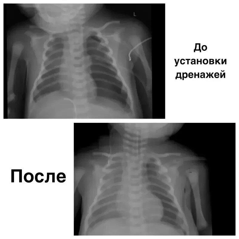 Красноярские врачи спасли новорождённого с тяжёлым поражением лёгких В...