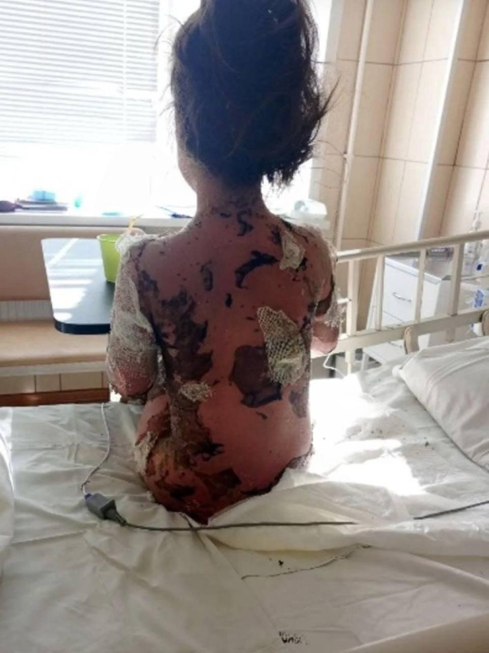 В Воронежской области у 7-летней девочки слезла кожа после приёма лекарства — врач назначила ей препарат без обследований