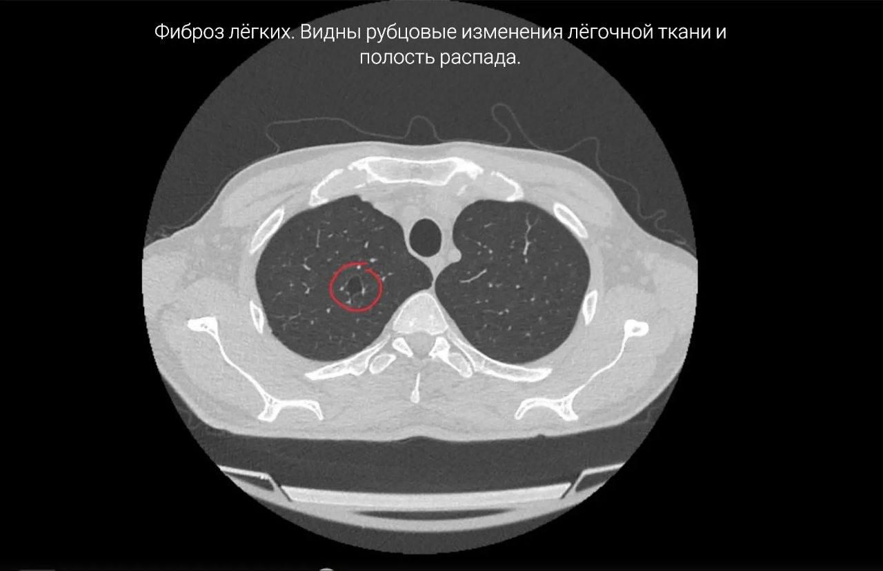 33-летний мужчина умер после многолетнего курения вейпов в Приморье
