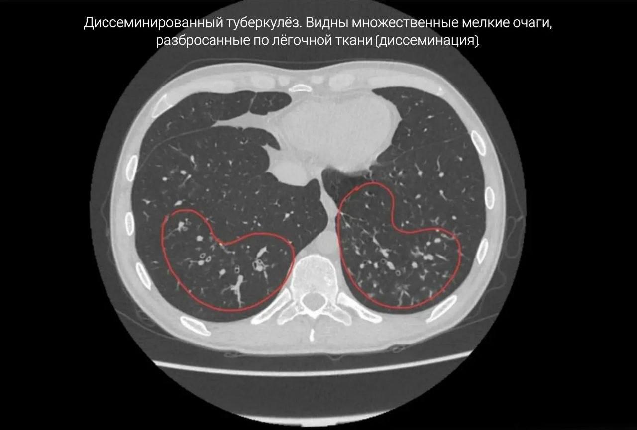 33-летний мужчина умер после многолетнего курения вейпов в Приморье
