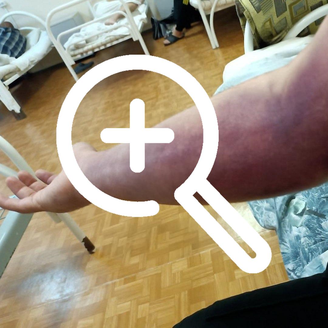 В Екатеринбурге пьяный мужчина хотел поймать гадюку, но оказался в реанимации