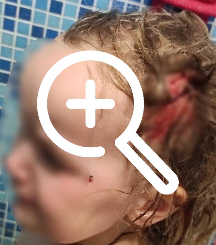 В Псковской области собака чуть не сняла скальп с 3-летней девочки