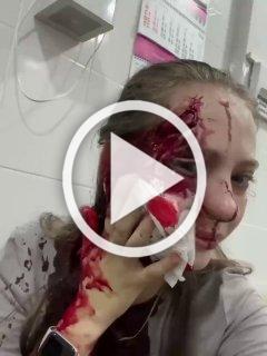 Подошёл, схватил за руку и разбил бокал: девушке изуродовали лицо «розочкой» из-за отказа познакомиться
