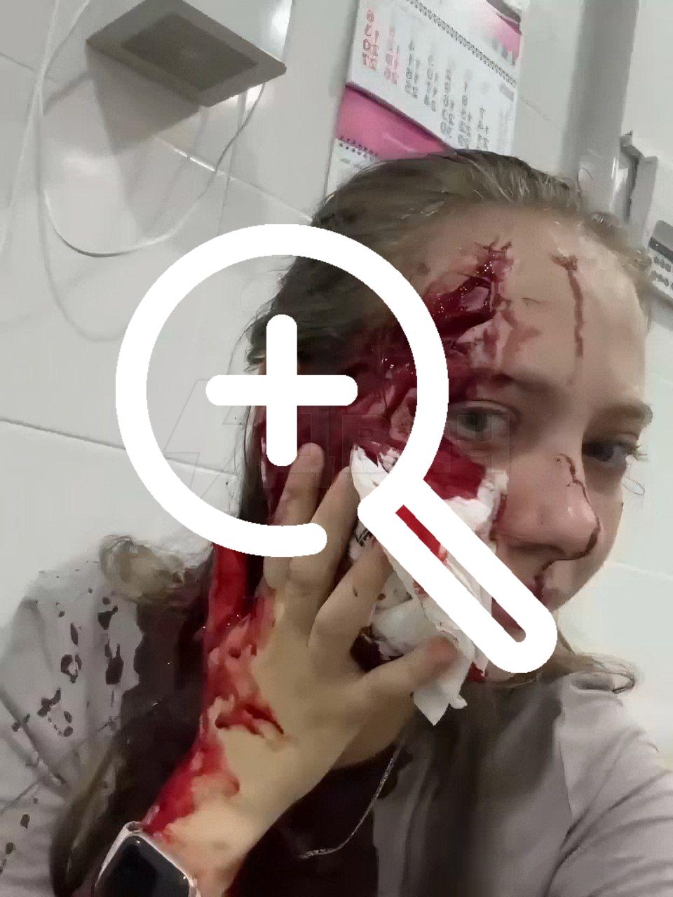 Подошёл, схватил за руку и разбил бокал: девушке изуродовали лицо «розочкой» из-за отказа познакомиться